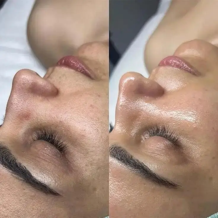 Hydrodermabrasion Before and After Hydrodermabrasion Before and After