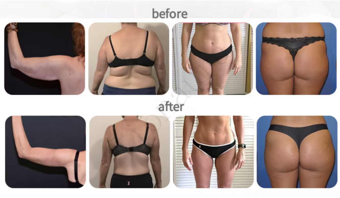 EMS body suit weight loss results and muscle toning before and after comparison