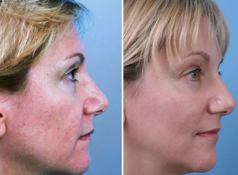 CO2 Laser Resurfacing