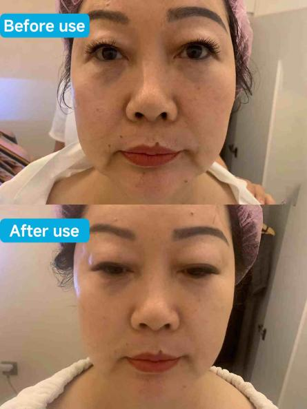 Comparison of the effect before and after using HIFU Machine