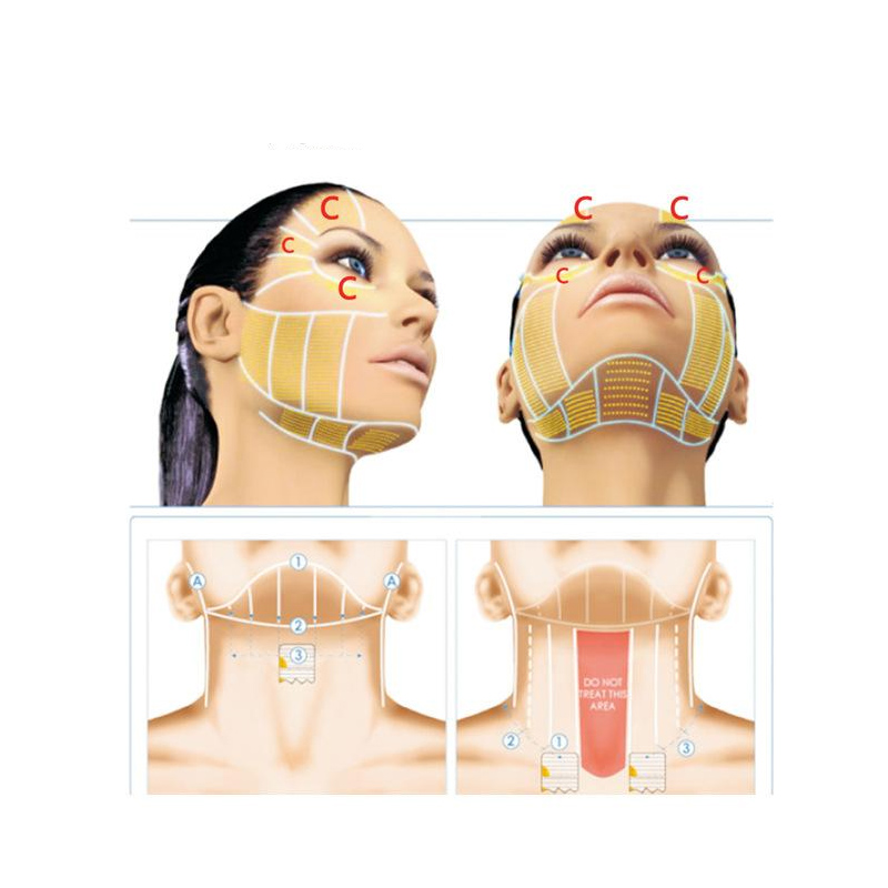 What Are The Benefits Of Using A Hifu Machine?