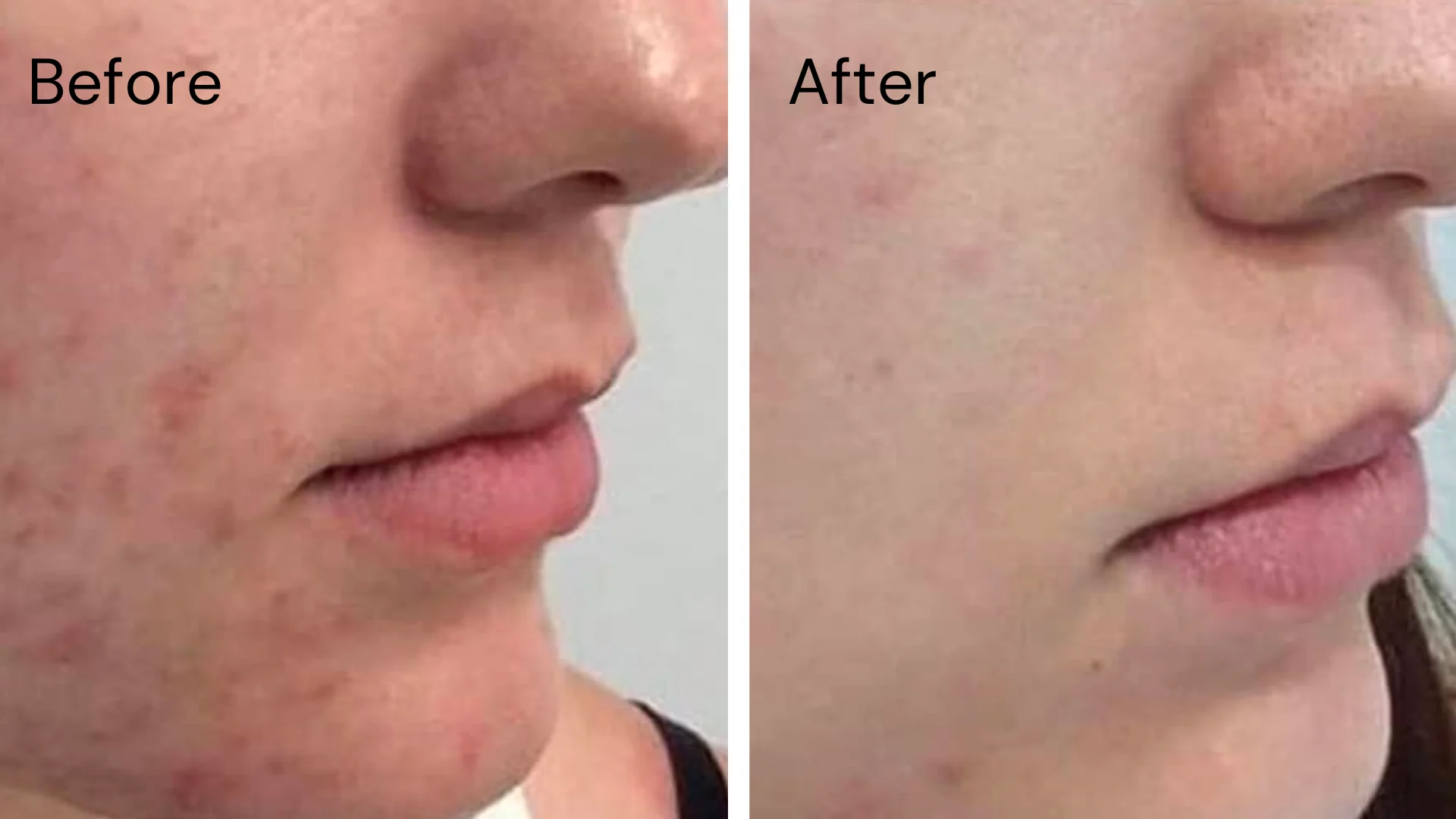 14 in 1 Bubble Hydrodermabrasion Machine Before & After