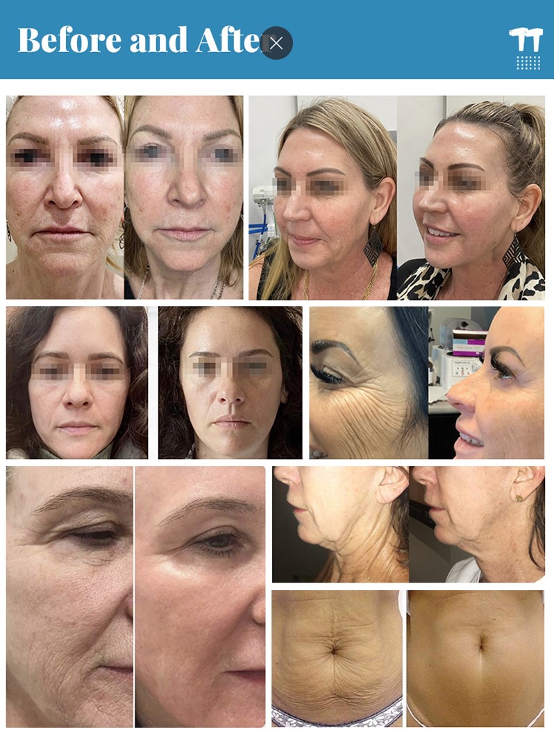 Before and After: RF Microneedling Machine