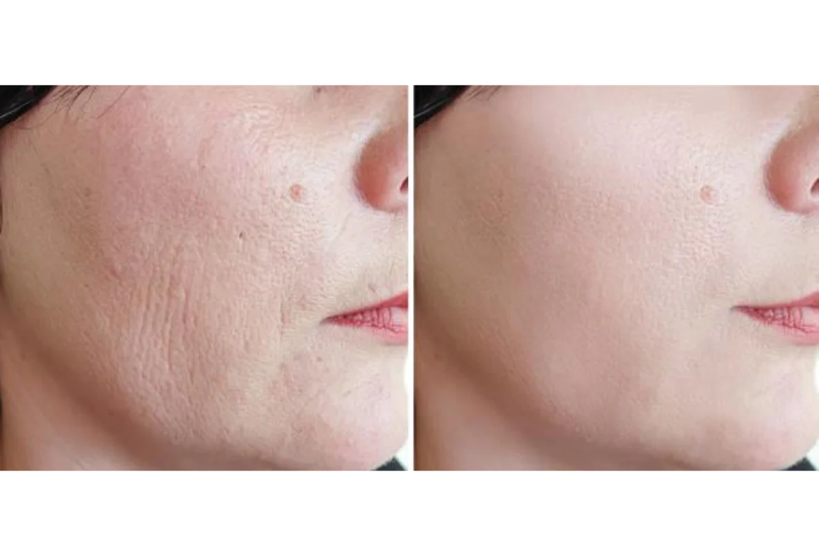 Aesthetic Results from Lionaura Clients