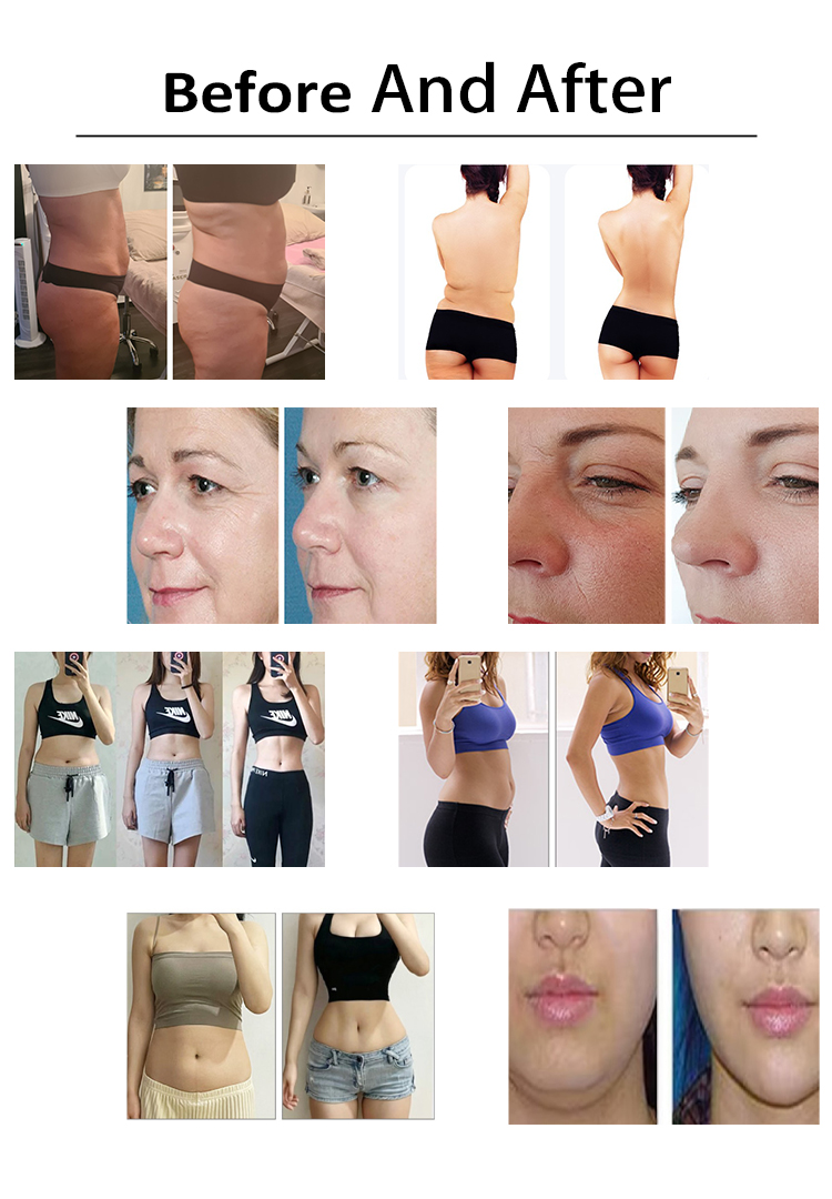 Professional 3-in-1 Lipo Cavitation Machine Before And After