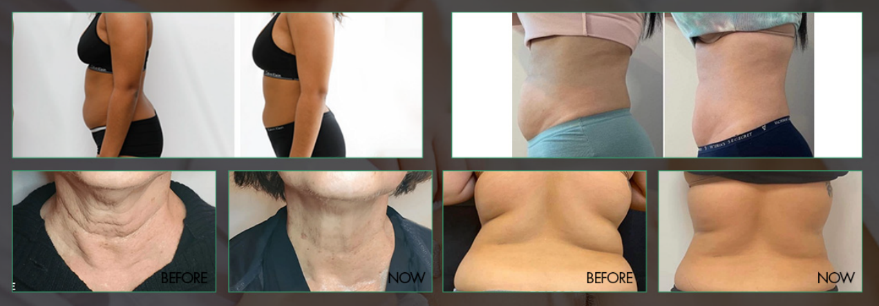 Professional Cryo Body Slimming Machine Before and After