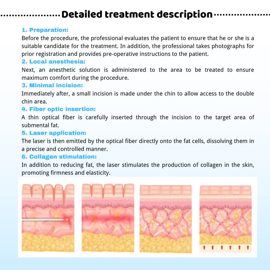 Step-by-step diagram of the Endolift procedure: from local anesthesia and fiber optic insertion to laser application for fat melting and skin tightening.
