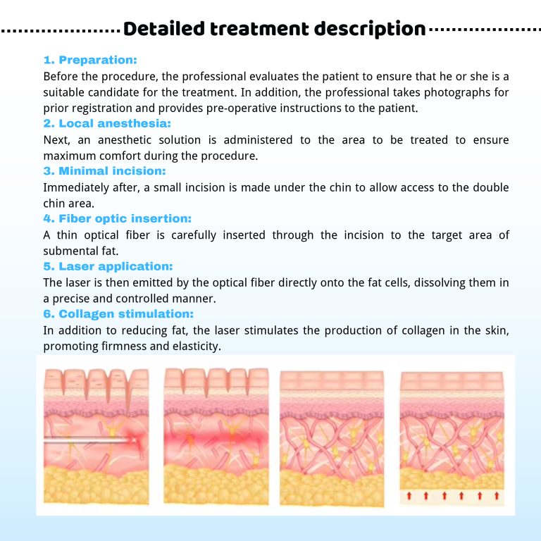 Step-by-step diagram of the Endolift procedure: from local anesthesia and fiber optic insertion to laser application for fat melting and skin tightening.