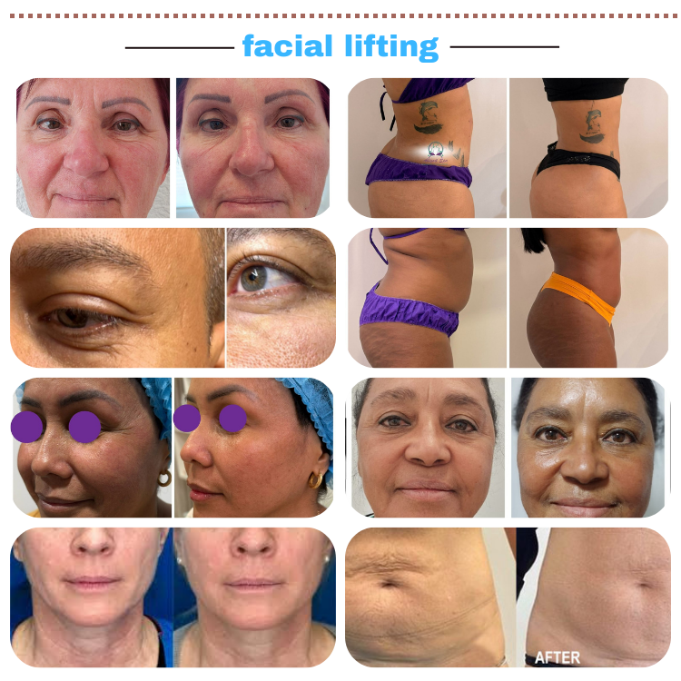 Endolift Before and After Results