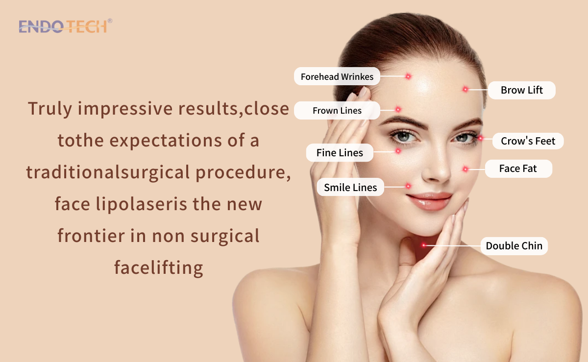 endolift treatment areas non surgical facelift double chin