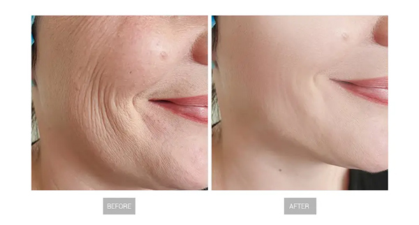 Before and After HIFU Treatment