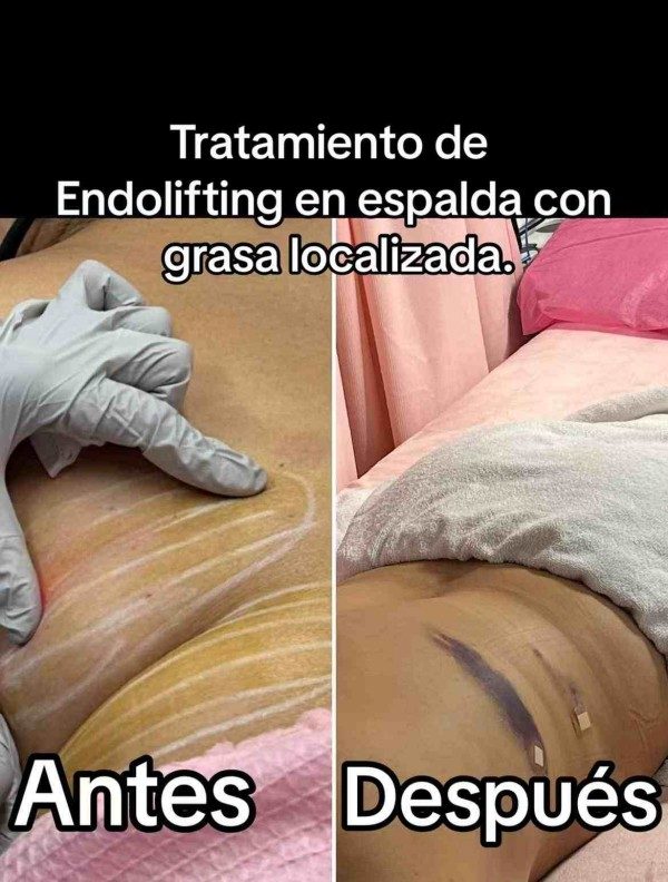 Tratamiento deEndolifting en espalda congrasa localizada.