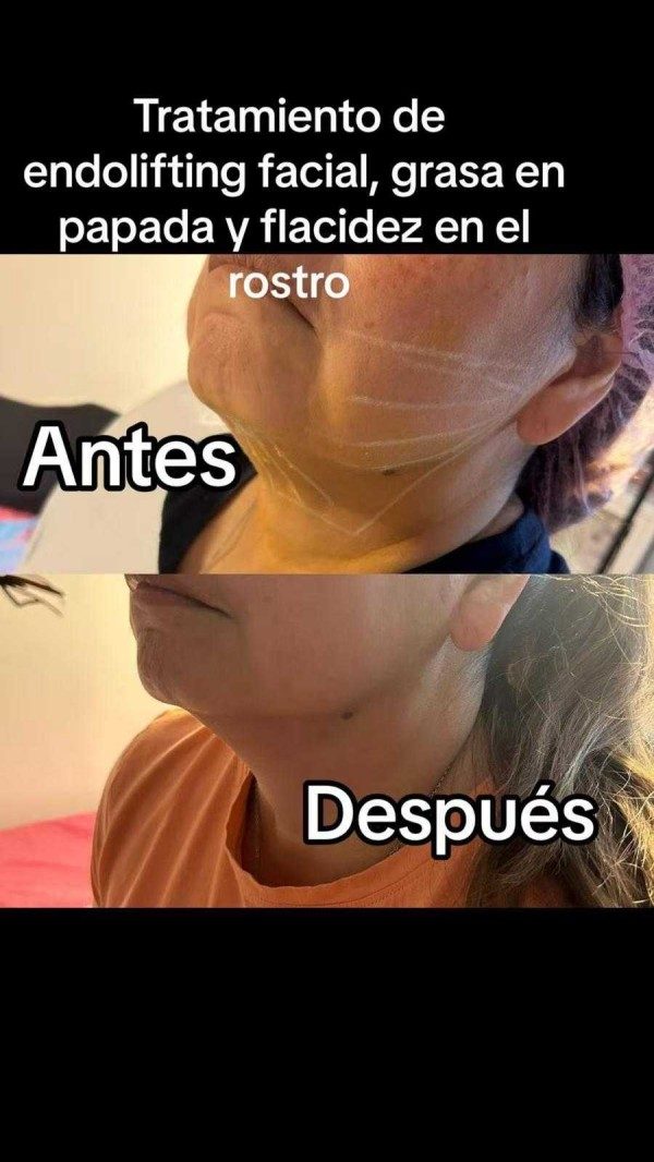 Tratamiento deendolifting facial, grasa enpapada y flacidez en elrostro
