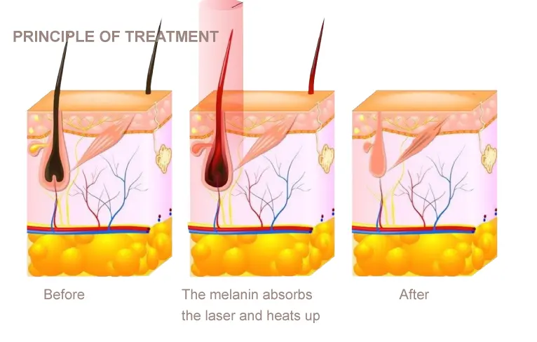 Diode laser working principle