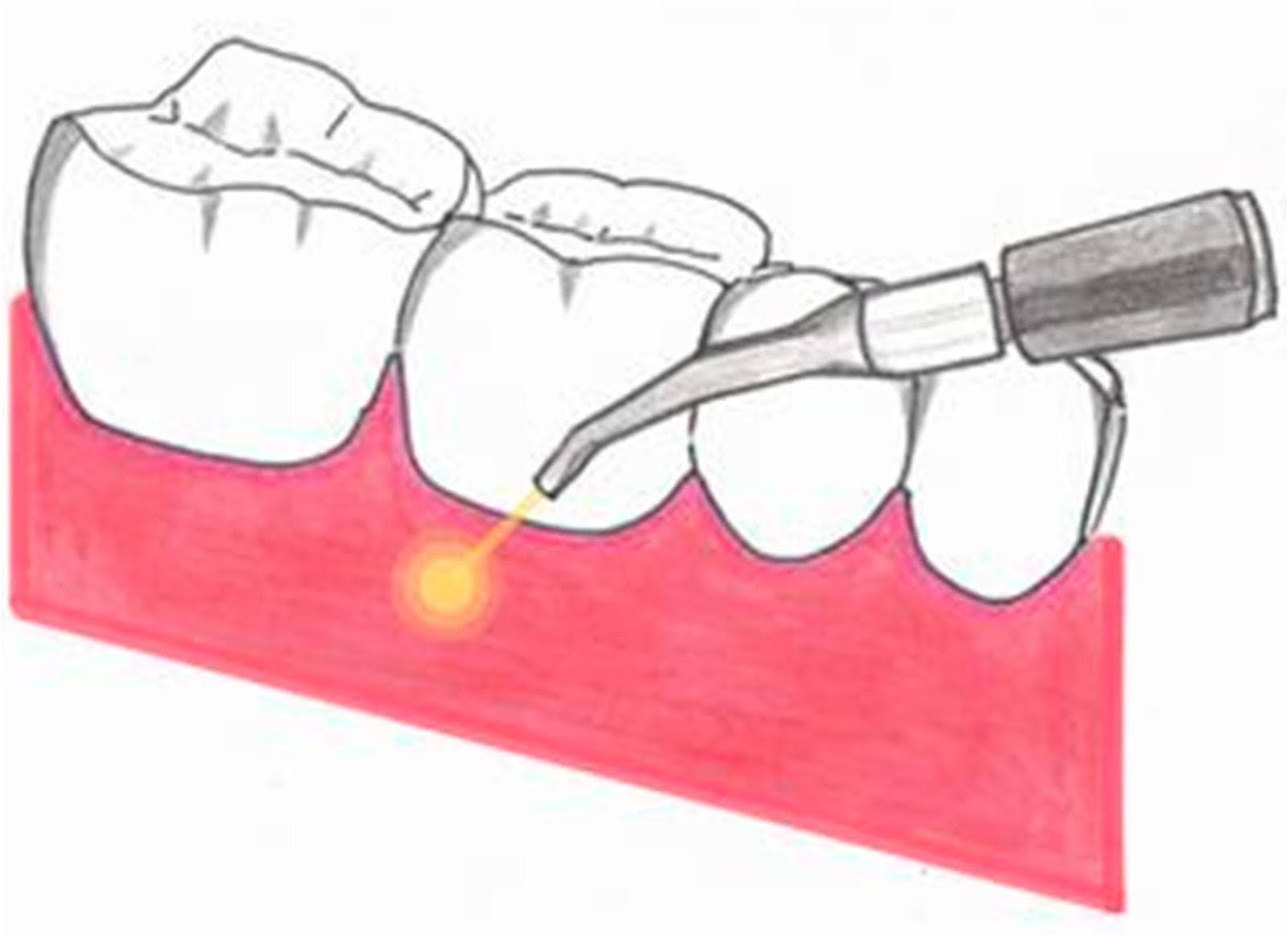 Dental Diode Laser