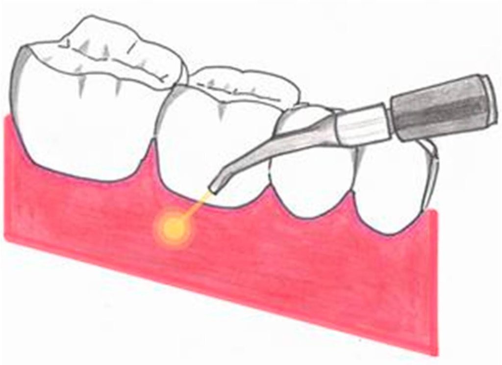 How Does a Dental Diode Laser Work