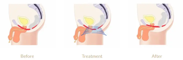 illustration of a man's weak pelvic floor
