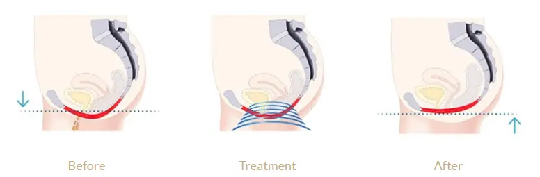 Illustration of a woman's weak pelvic floor