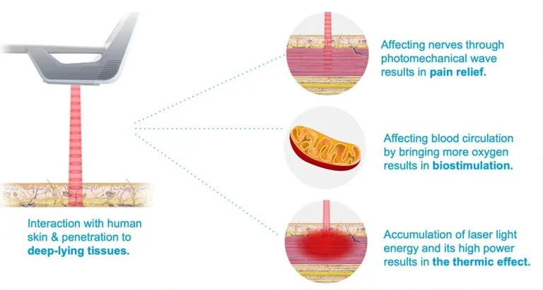 How High-Intensity Laser Therapy works
