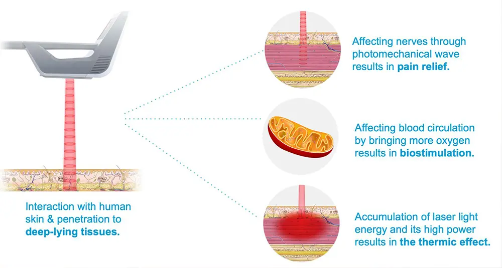 How High-Intensity Laser Therapy works