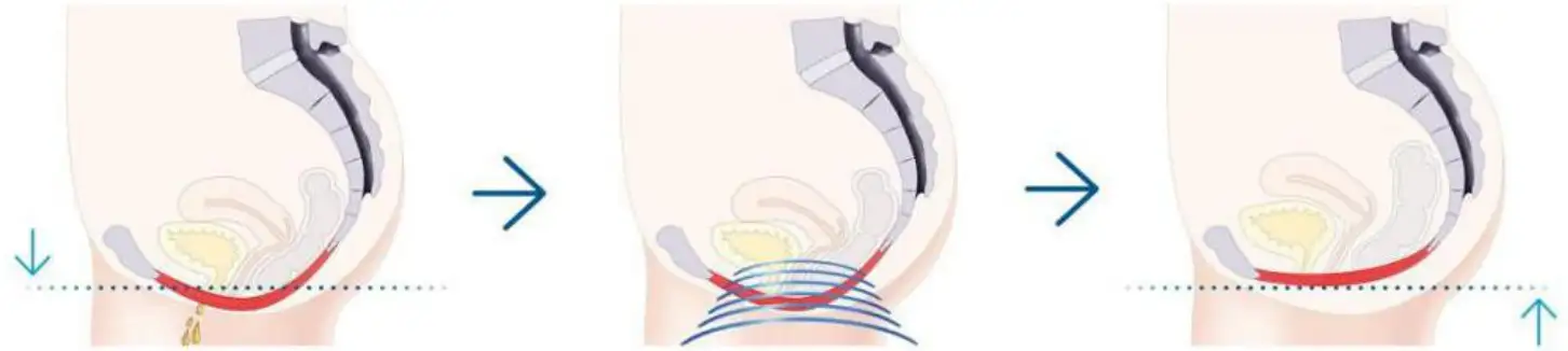 Working Principle of the Pelvic Floor Chair