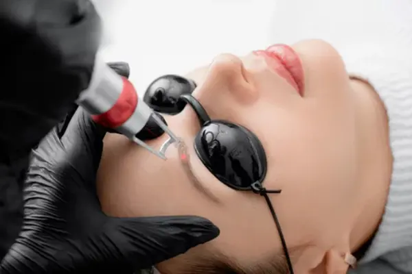 Carbon Laser Peel