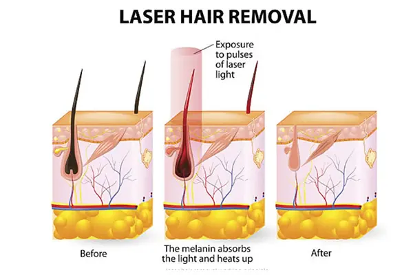 Efficient Hair Removal