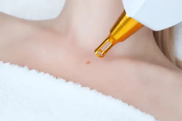 Pigmentation Treatment