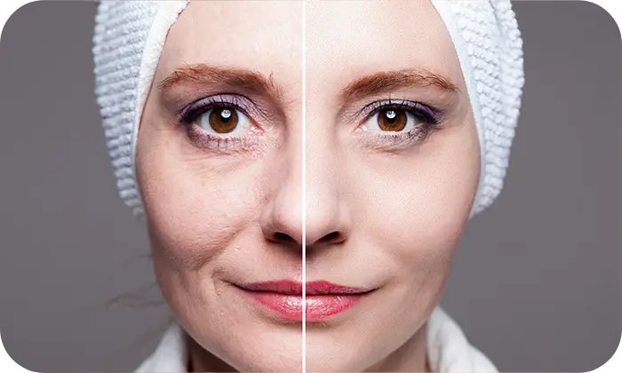 endolift