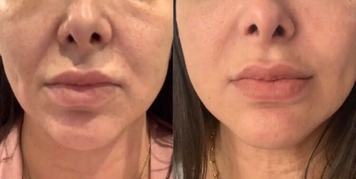 HIFU Before & After