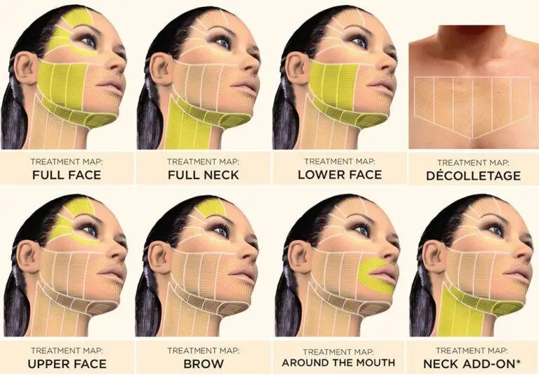 High-Intensity Focused Ultrasound (HIFU) Facial Treatment Areas