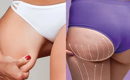 Buttock & Thigh Treatments