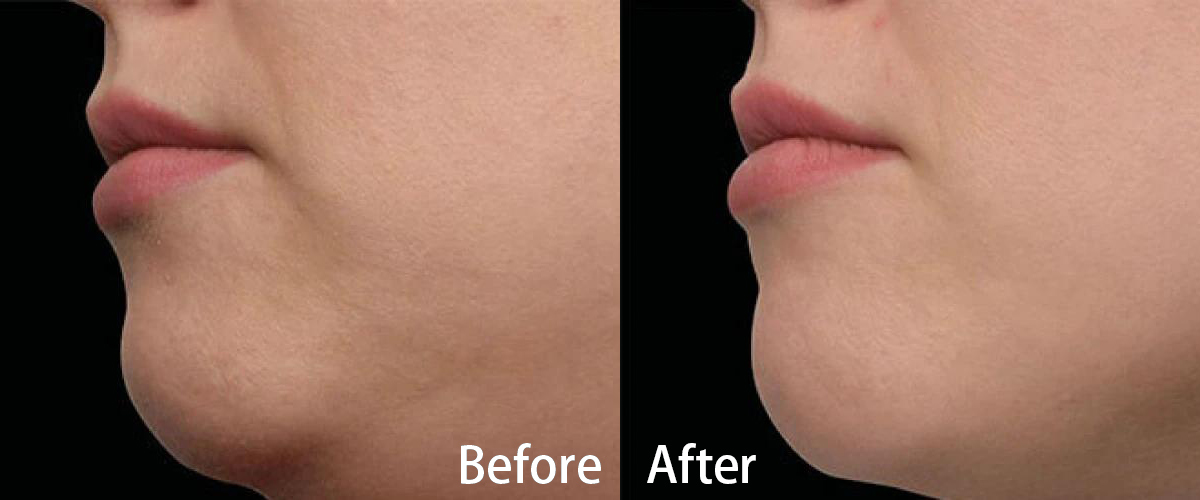 Cryo HIFU Machine Before & After